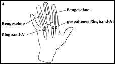 Синдром щелкающего пальца